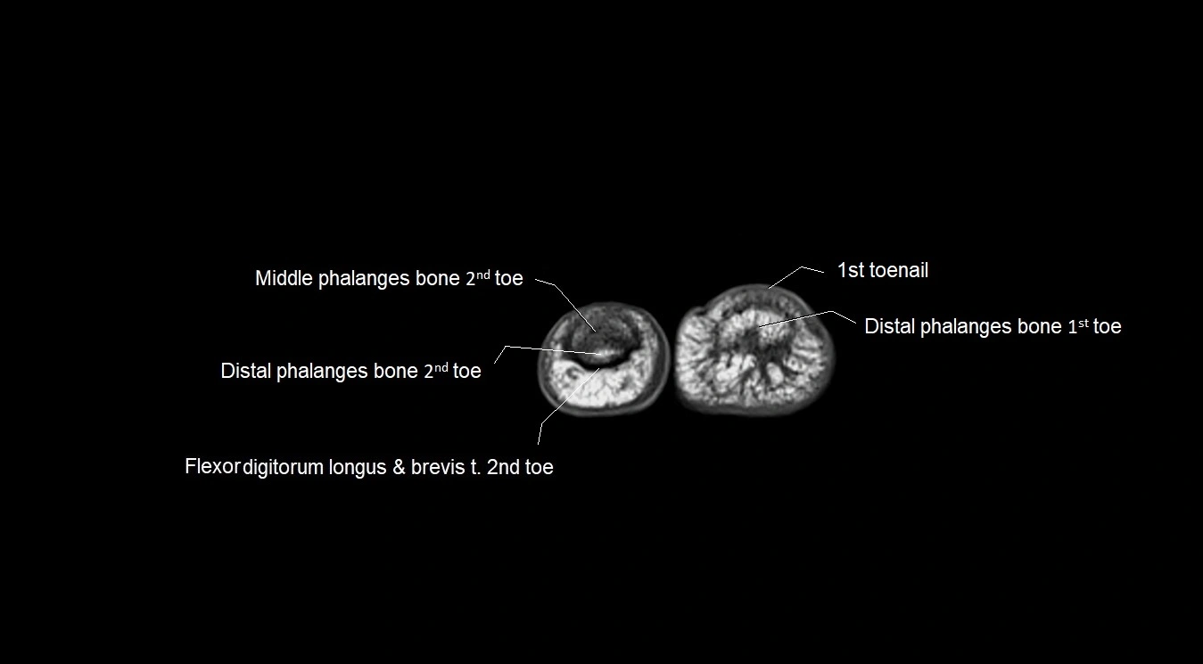 MRI 3T foot axial cross sectional anatomy image 43.webp